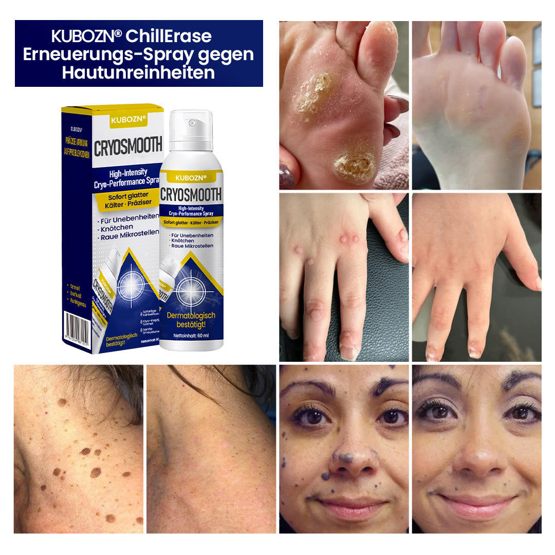 Dermatologisch geprüft ⚕️ KUBOZN® ChillErase Spray gegen Warzen & Muttermale ❄️ Sichtbare Ergebnisse in 5 Tagen
