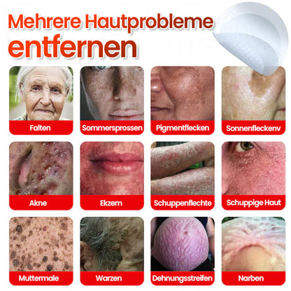 Cvreoz® Mikronadel Botanisches Hautanhängsel-Entfernungspflaster