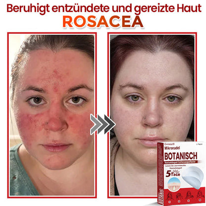 Cvreoz® Mikronadel Botanisches Hautanhängsel-Entfernungspflaster