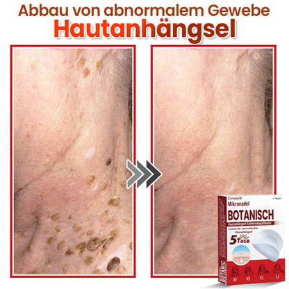 Cvreoz® Mikronadel Botanisches Hautanhängsel-Entfernungspflaster