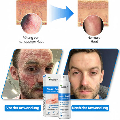3-Minuten Linderung⚡KUBOZN® Magnesium Kräuter-Spray für Psoriasis-neigende Haut