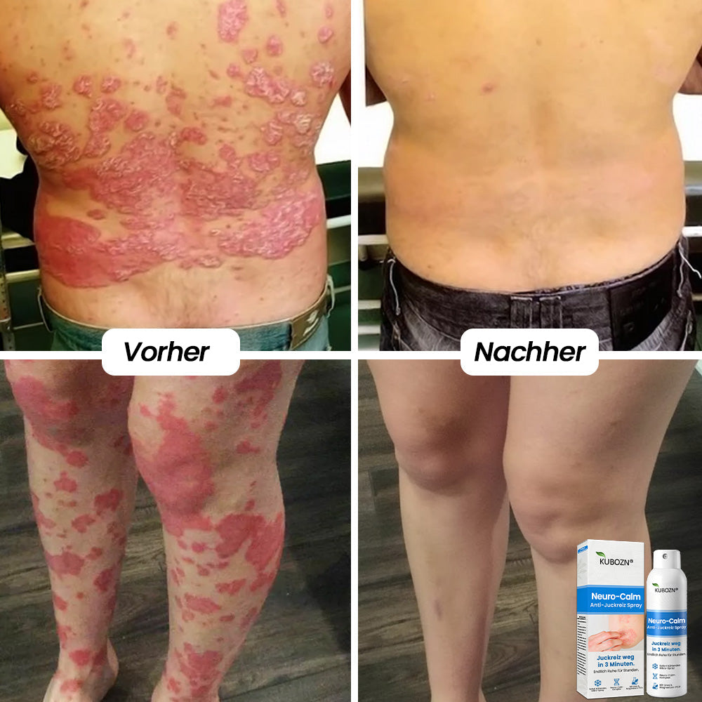 3-Minuten Linderung⚡KUBOZN® Magnesium Kräuter-Spray für Psoriasis-neigende Haut