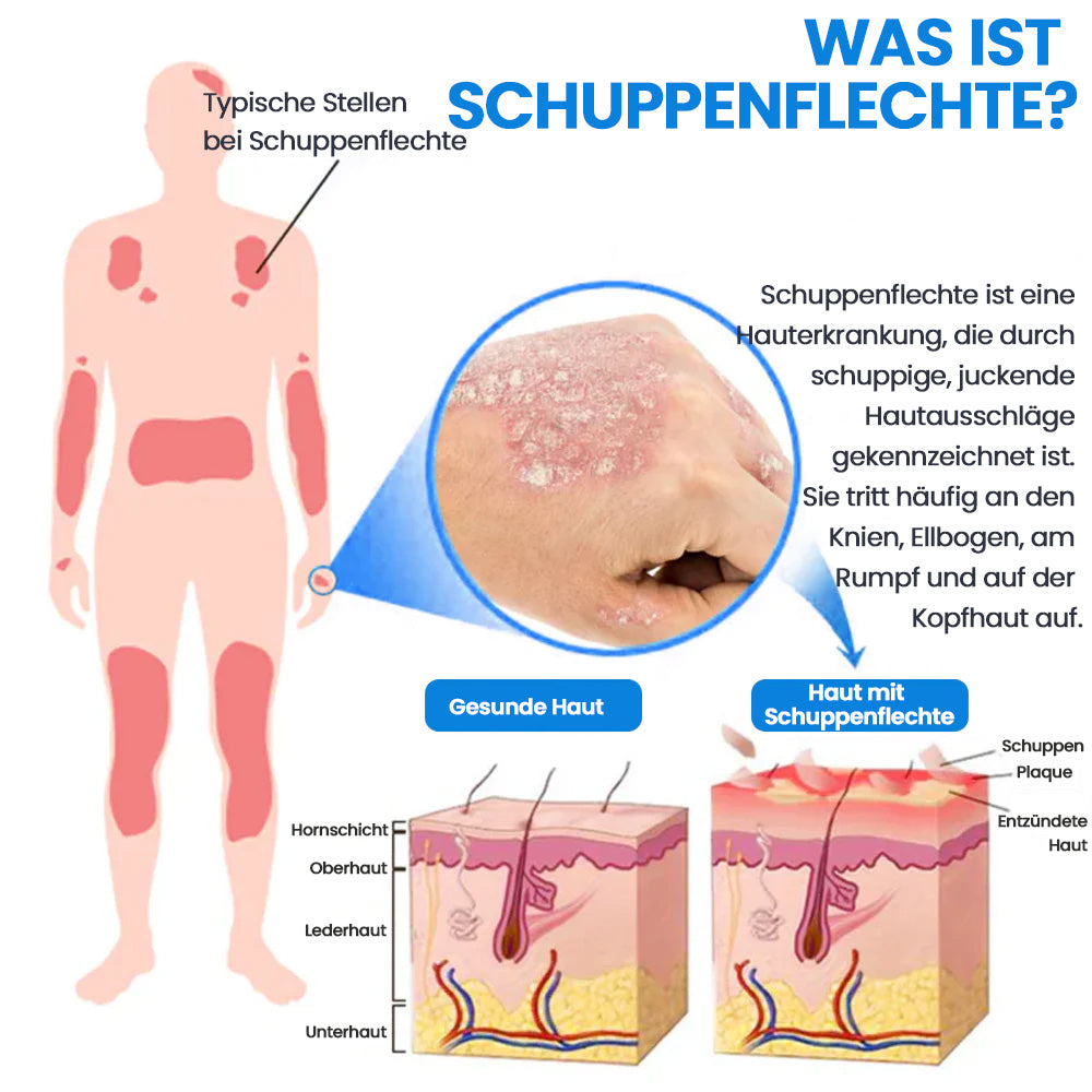3-Minuten Linderung⚡KUBOZN® Magnesium Kräuter-Spray für Psoriasis-neigende Haut