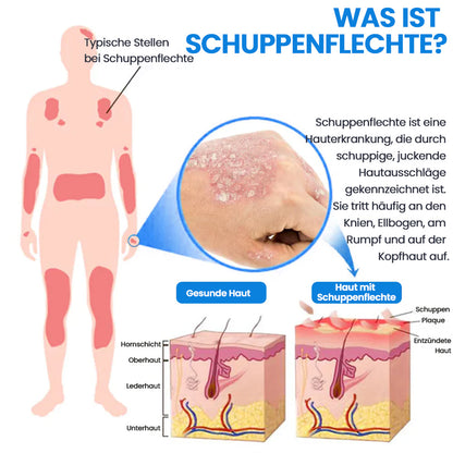 3-Minuten Linderung⚡KUBOZN® Magnesium Kräuter-Spray für Psoriasis-neigende Haut
